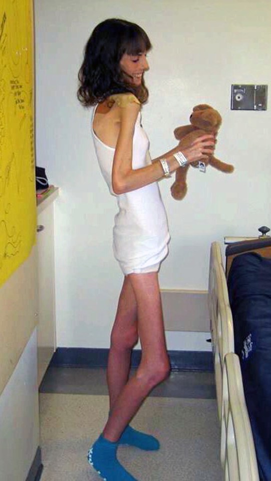 Anorexic to over weight