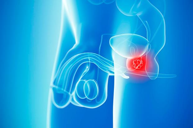 Many men don't notice the signs and symptoms of prostate cancer until the disease is in the later stages