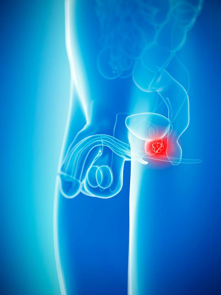 prostate cancer