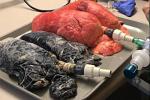 A healthy set of lungs lies next to a disease-riddled pair, from a smoker who puffed away on a pack of fags a day