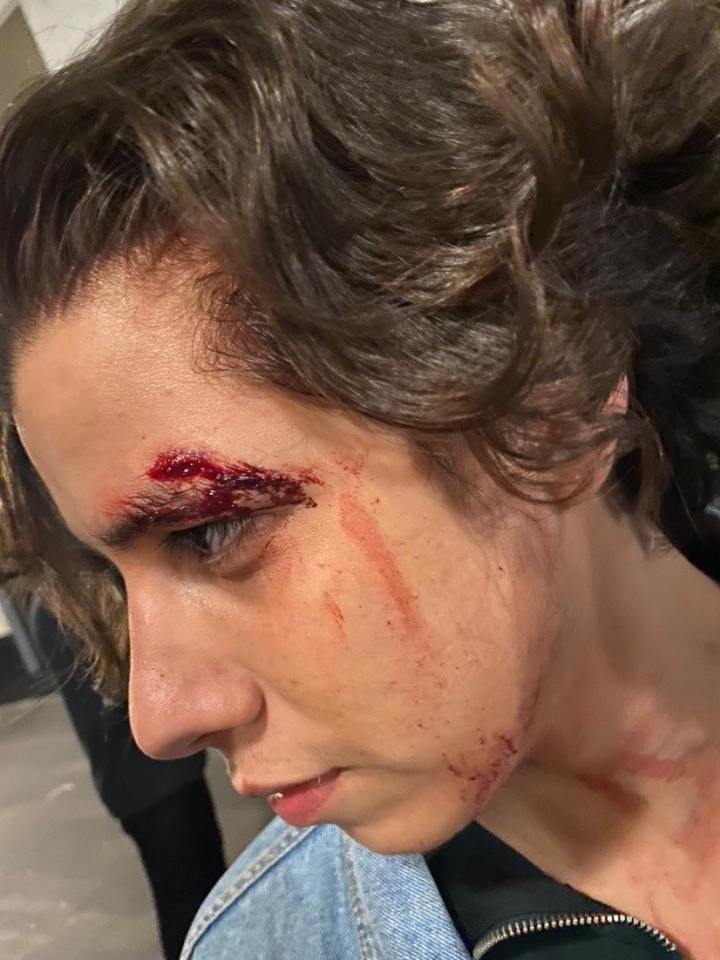 Bathuel Araujo, 21, needed four stitches for a gash next to his eye