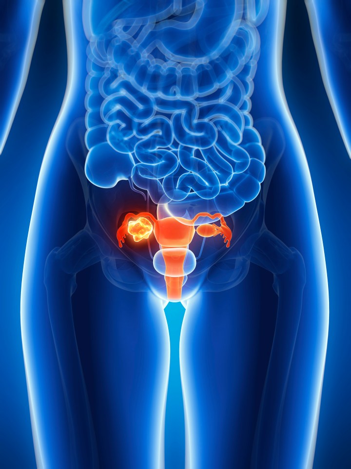Illustration of ovarian cancer.