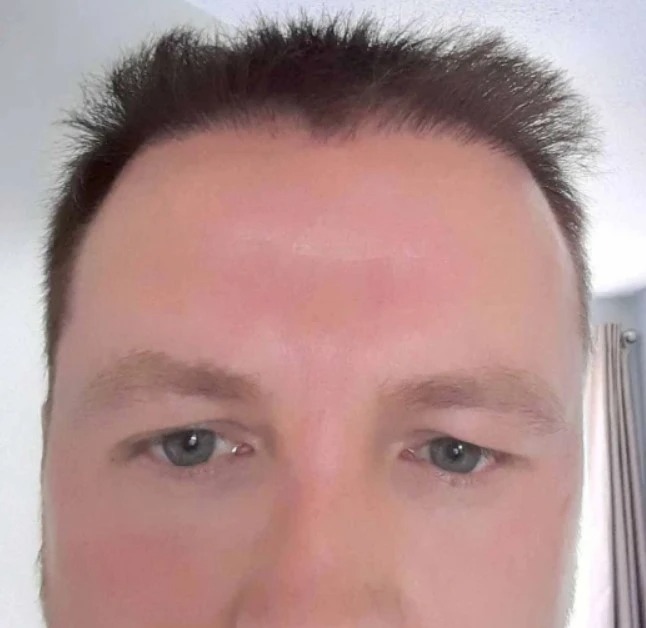 Phil said the surgery left him with a hairline that stuck up 'like a toothbrush'