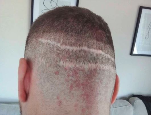 Dr Mittal's client Phil Whitehouse spoke about how a botched hair transplant ruined his life