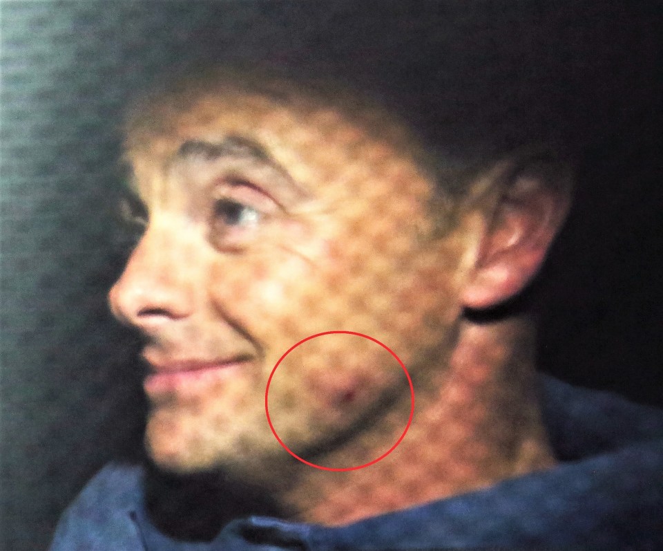 Ant McPartlin displayed a nasty looking bruise after falling onstage during BGT's semi-finals last night