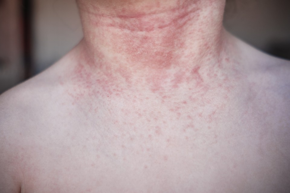 Luke Thomas died after developing a rash which was a symptom of an autoimmune disease (stock photo)