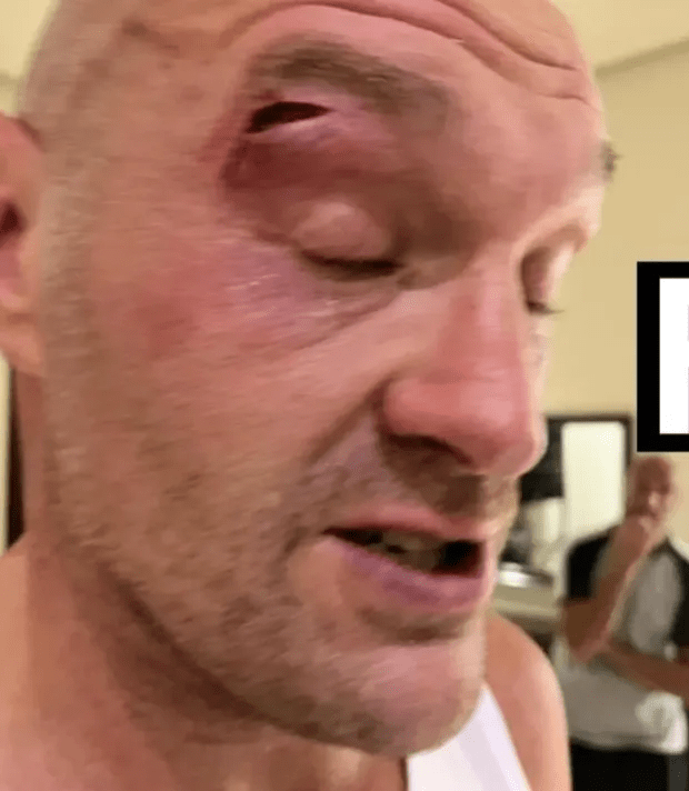 Fury sustained a cut over his eye in sparring