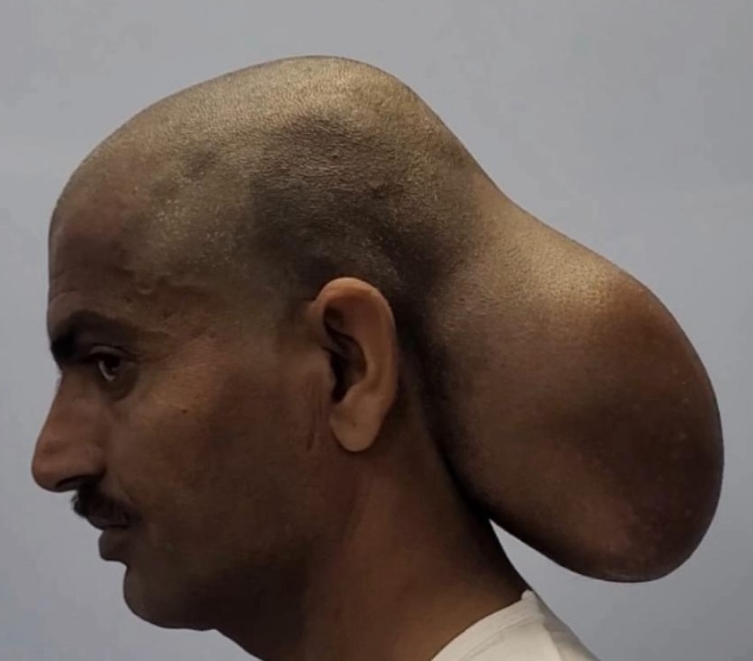 A 39-year-old man's tumour was so large he looked like he had two heads