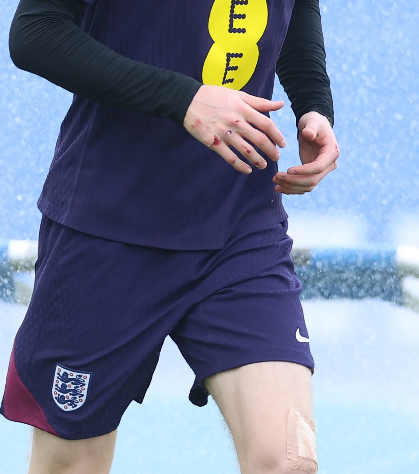 Gordon also sported nasty injuries to his hands and leg following the high-speed crash