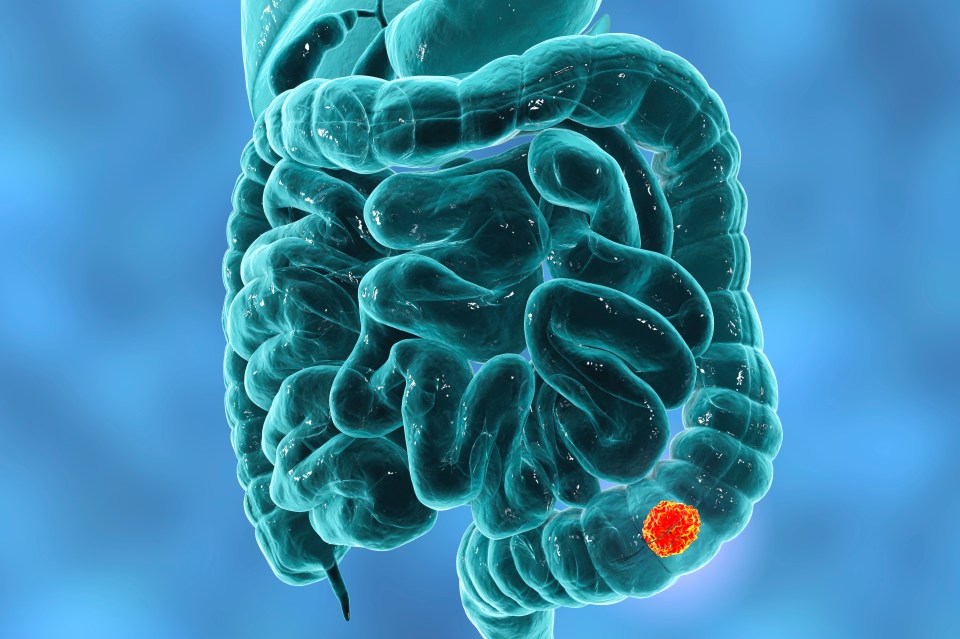 a computer generated image of a large intestine with a red circle in the middle