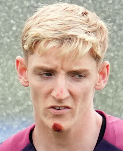 Anthony Gordon may have got his brakes mixed up when he tumbled from his e-bike as he was spotted with injuries on his face