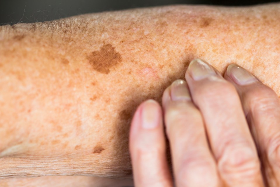 a close up of a person 's arm with spots on it
