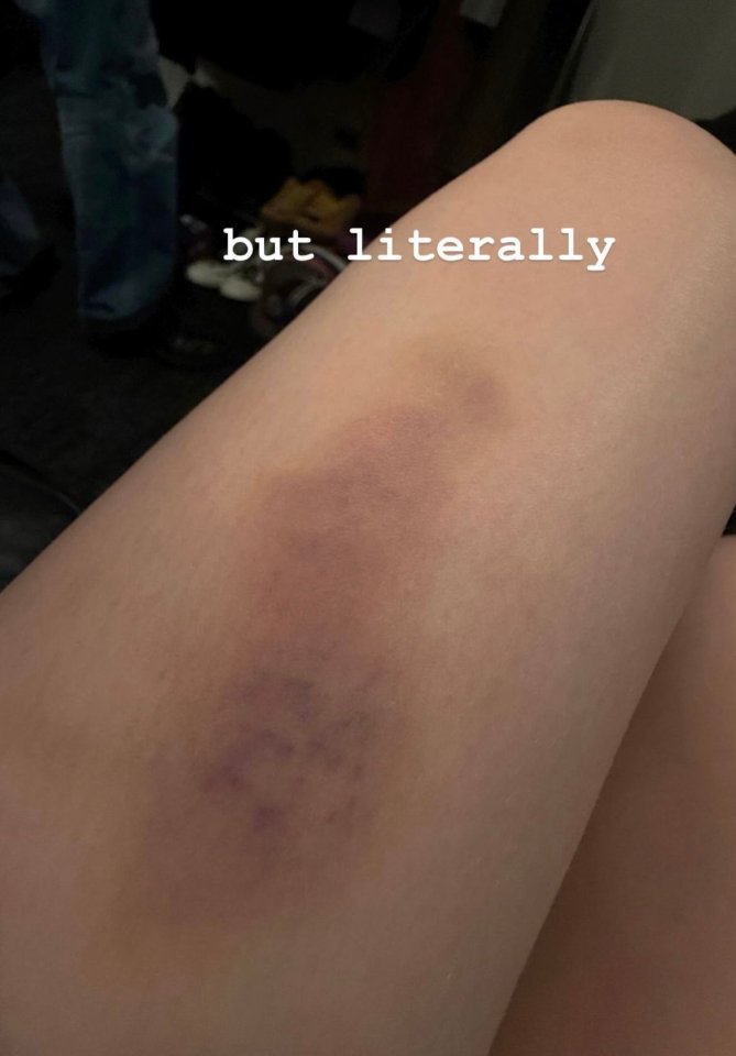 a person 's leg with a bruise and the words but literally below it