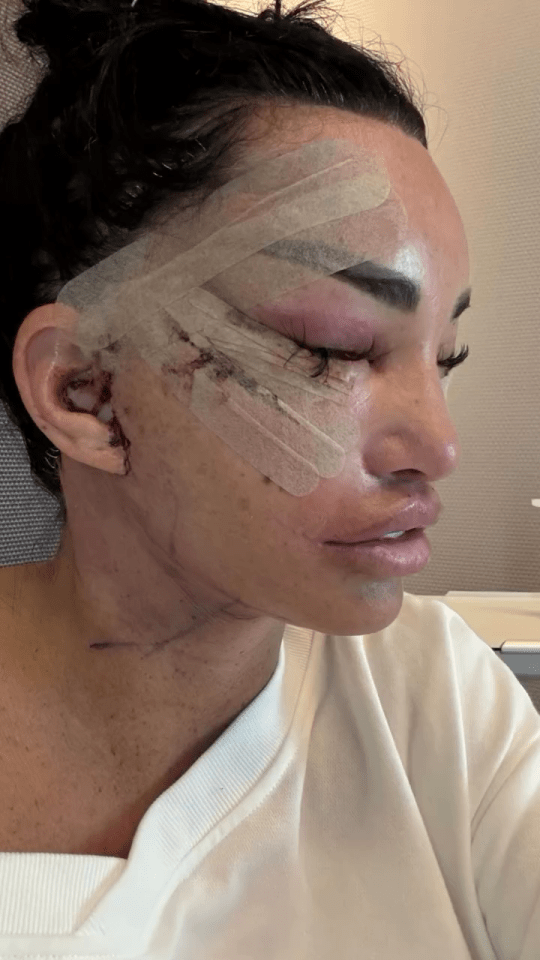 a woman with a bandage on her face has a black eye
