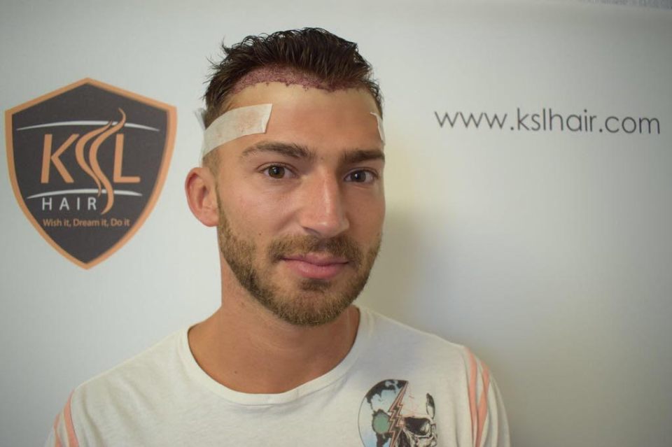 Man with bandages on his forehead after a hair transplant.