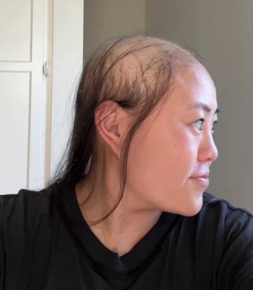 Person with short hair after experiencing hair loss in 2024.