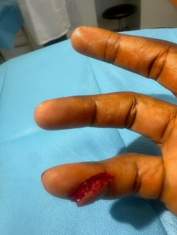 Close-up of a finger with a deep laceration.