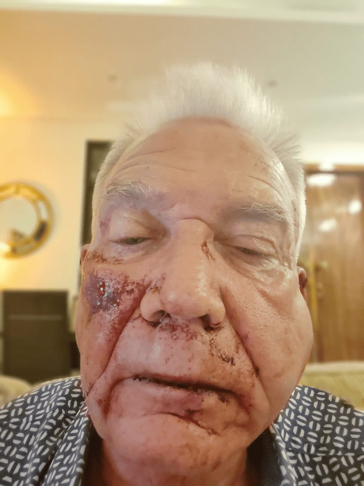 Close-up of a man's severely bruised and bleeding face.