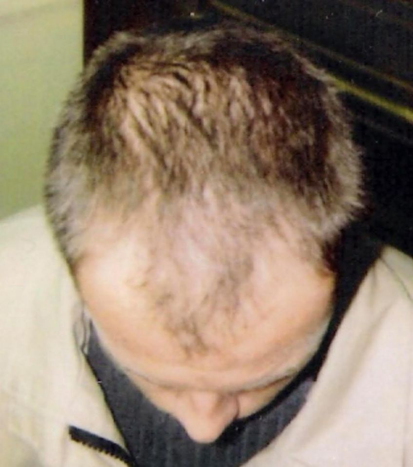 Man's head showing hair transplant results.