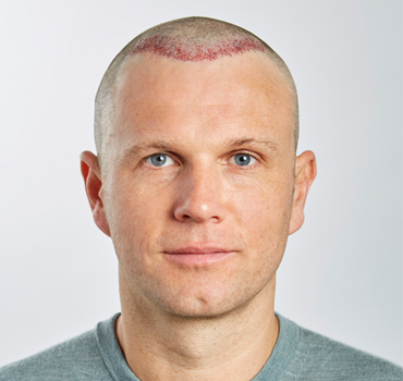 Man with a hair transplant.