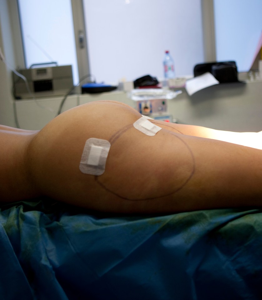 Post-liposuction patient's thigh with bandages.