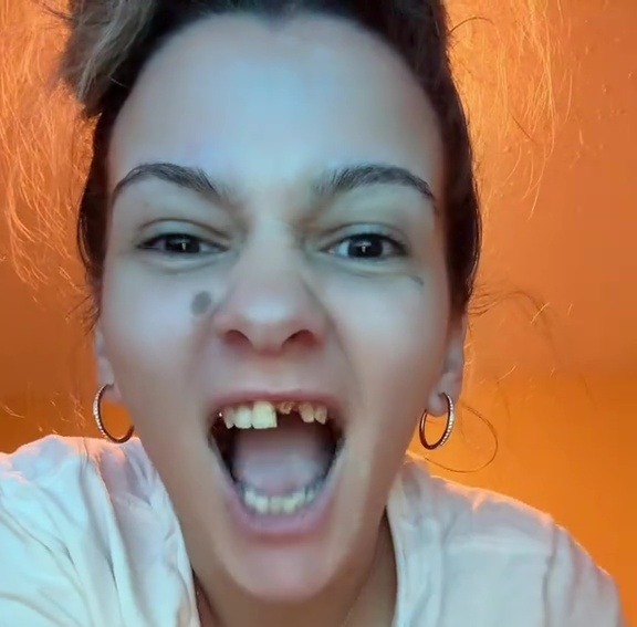 Woman showing damaged teeth, three days before traveling to Colombia for dental work.