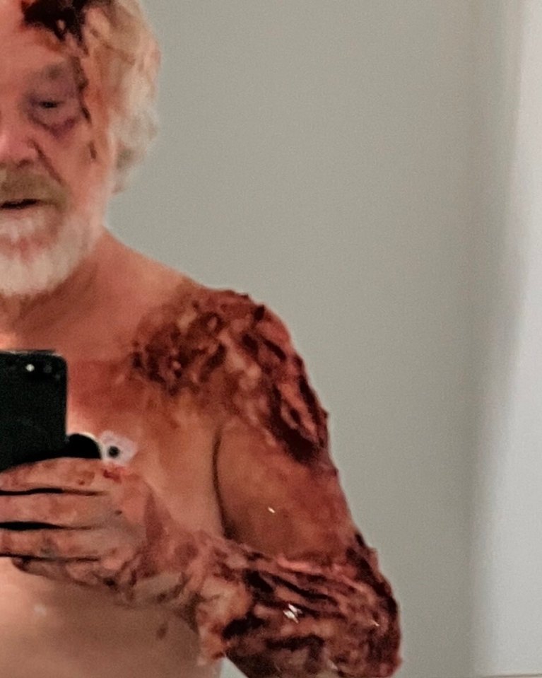 A man with injuries to his face and upper body takes a selfie.