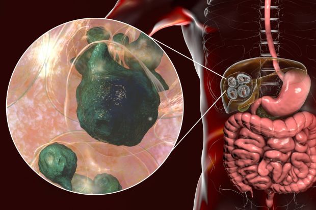 An image collage containing 1 images, Image 1 shows Illustration of hydatid disease in the liver caused by parasitic tapeworm larvae