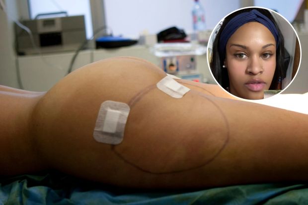 An image collage containing 2 images, Image 1 shows Post-liposuction patient's thigh with bandages, Image 2 shows Woman in a red shirt with a smaller inset image of a woman in a colorful shirt and jeans