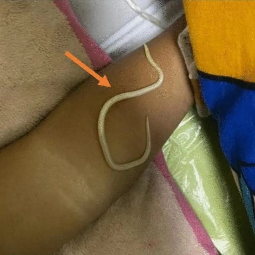 A roundworm on a child's arm.