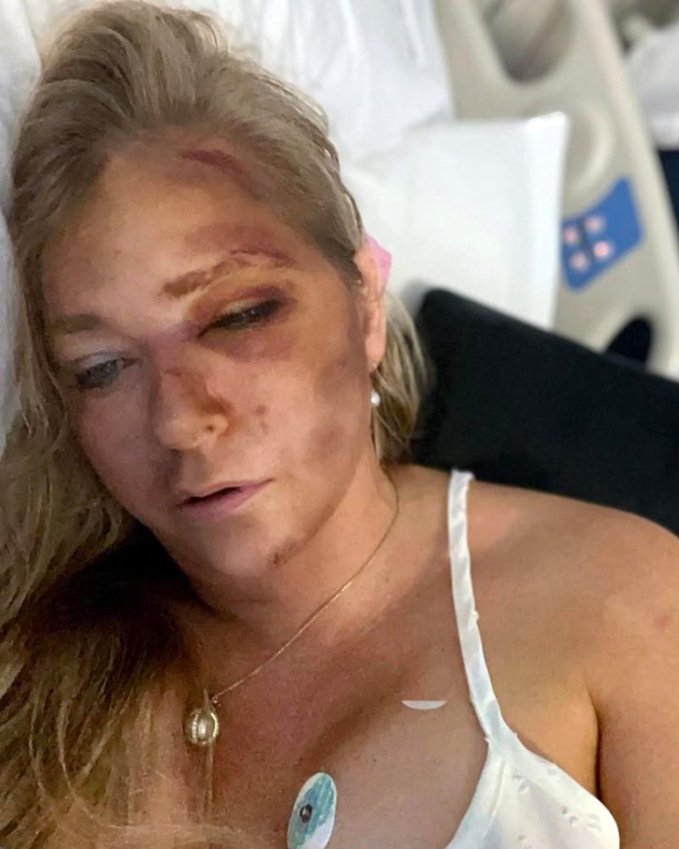 Woman in hospital bed with facial injuries.