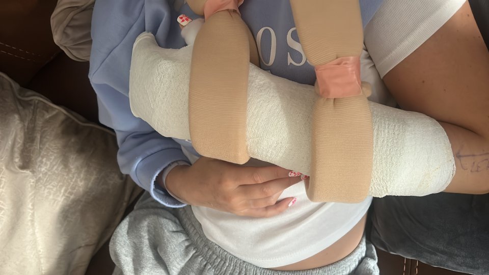 Woman's arm in a cast after a shark bite.