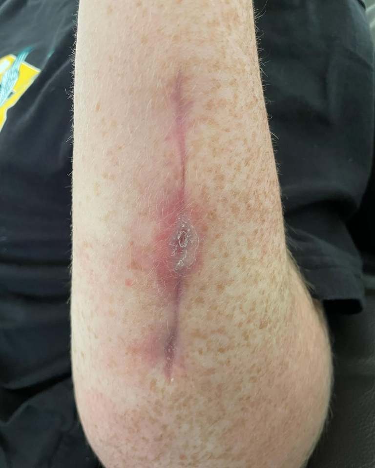 Close-up of a healing wound on an arm.