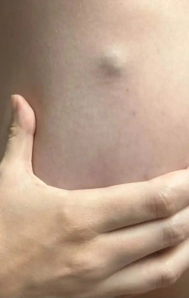 Close-up of a lump on a person's skin.