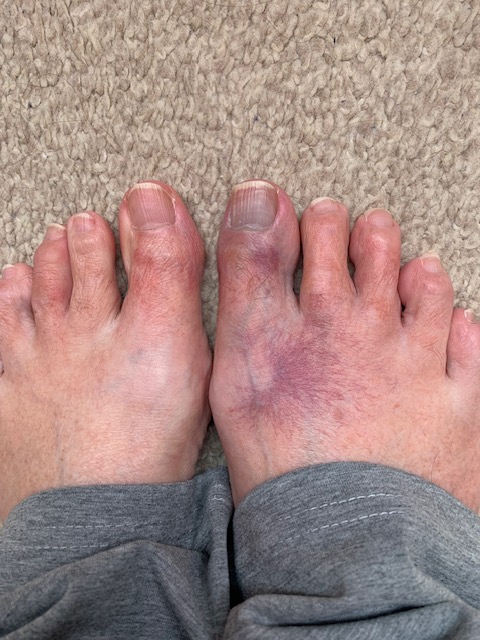 Bruised feet.