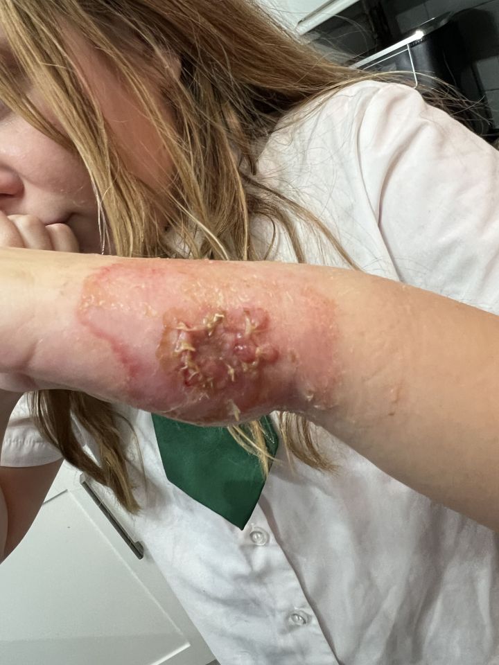 Close-up of a girl's arm with a severe burn.