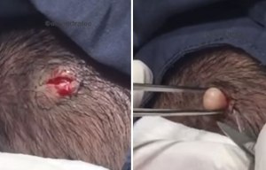 Dr Pimple Popper bursts open a gunk-filled cyst on a man’s SCALP and pushes the pus out