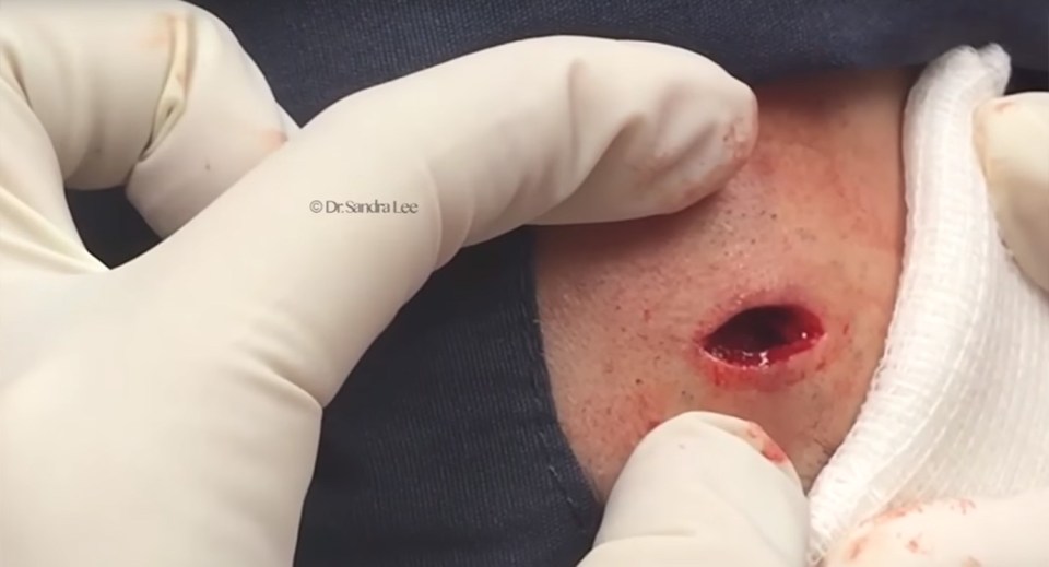 Once Dr Sandra Lee has removed the non-cancerous lump, she then sews the man's forehead back up