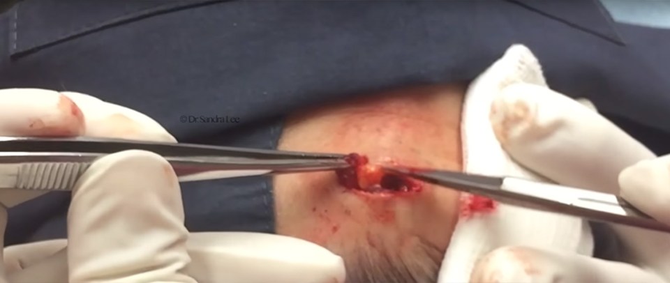 The medical professional starts the procedure by slicing open the patient’s head before embarking on removing a lipoma, a slow-growing, benign growth of fat cells