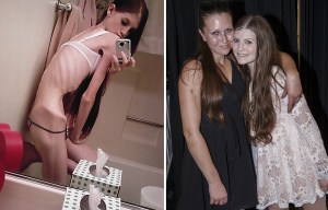 Anorexic sisters who COMPETED to be the thinnest are finally on the road to recovery