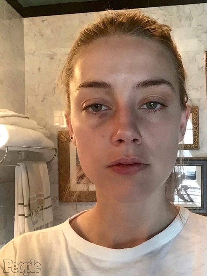 Amber's bruised face was seen when she attended court as part of the divorce battle