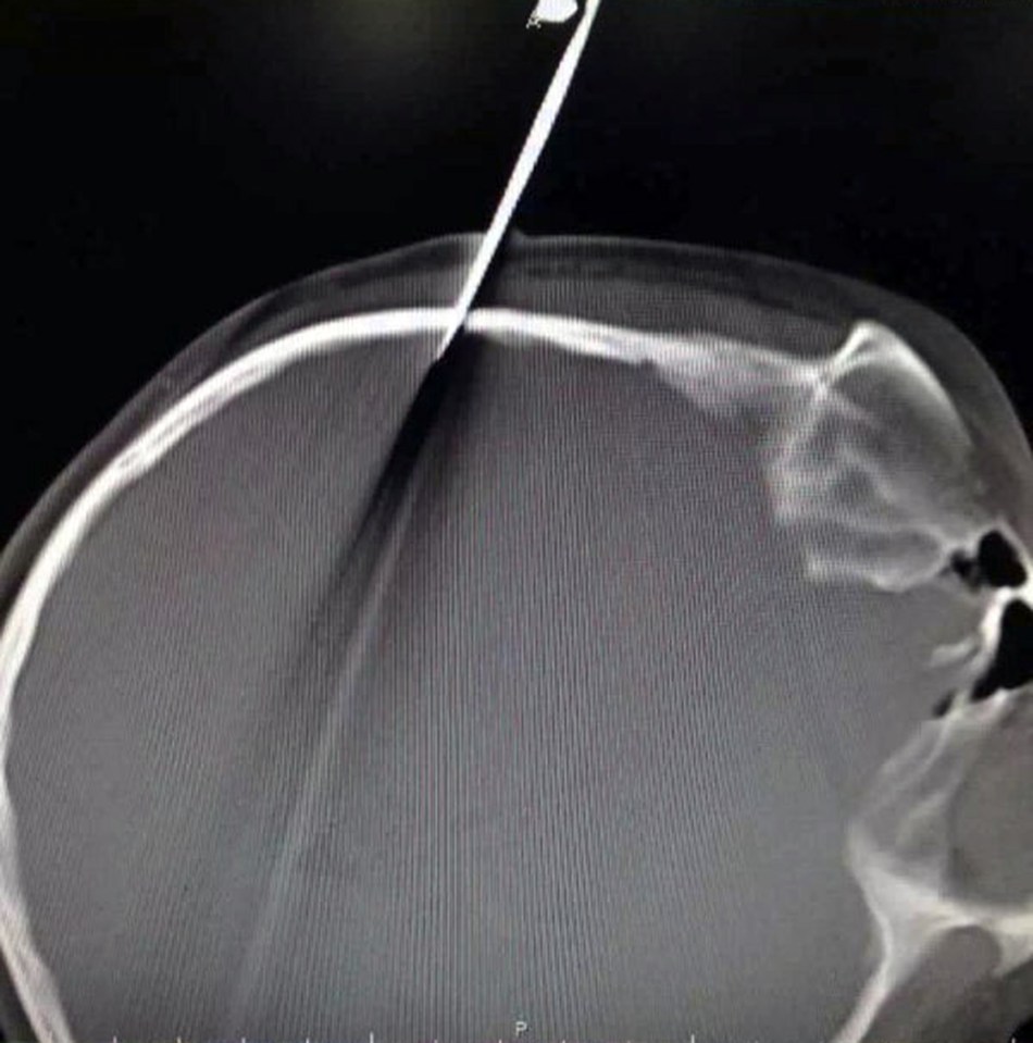 scissor x-ray