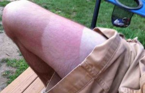 Man’s leg bears an uncanny resemblance to NEAPOLITAN ICE CREAM after sunburn blunder