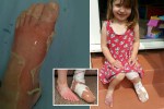 Bath burns