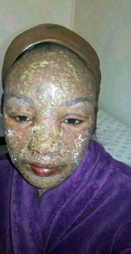 The mother-of-two was first diagnosed with chicken pox