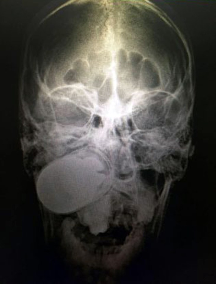 X-rays later showed the extend of the man's injuries, with the grenade firmly embedded inside his face
