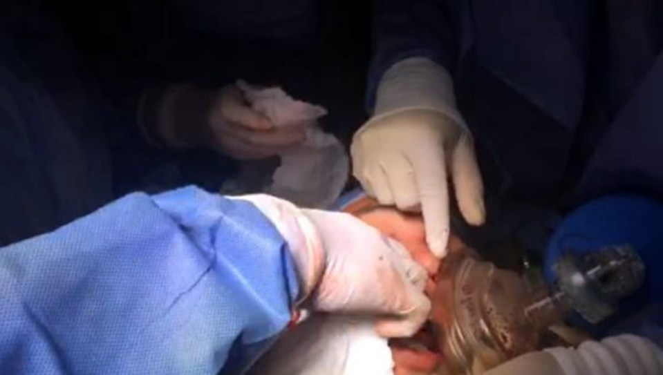 After hours of careful surgery, they were able to extract the explosive from the face and save the man's life