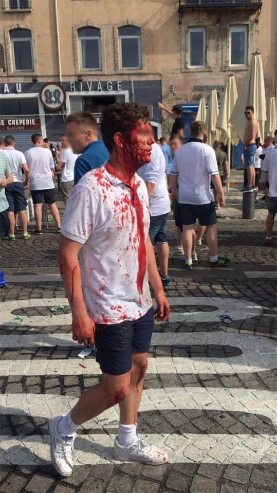 England fan covered in blood after suffering head wound in running street battle