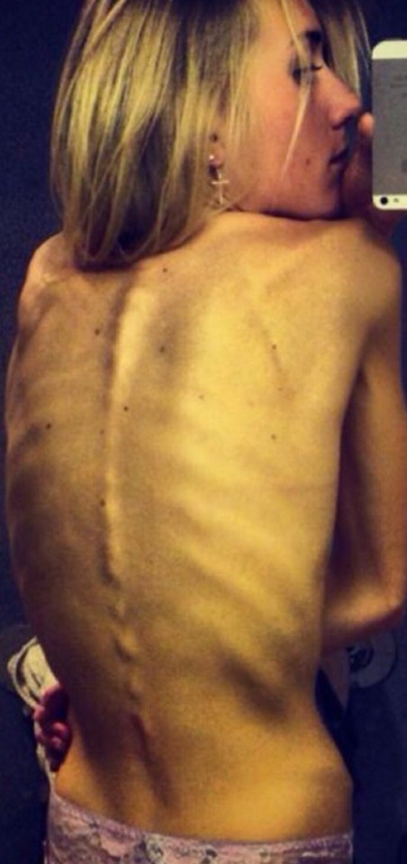 Anorexic recovery 