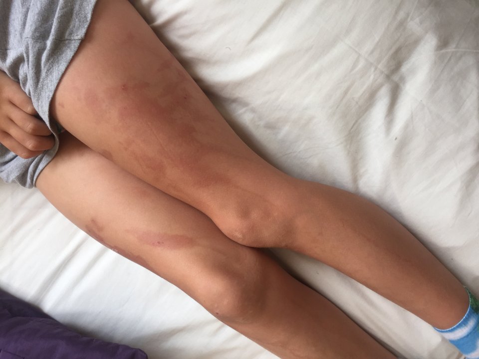 Olivia was enjoying the holiday of a lifetime in Mexico before her legs were burnt by the suntan lotion 